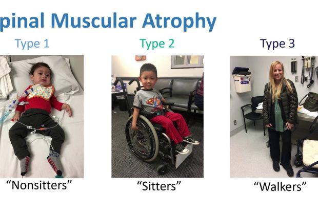Understanding SMA Type 1: Implications and Insights – Invisiverse News