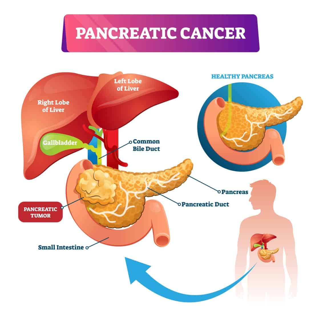 Understanding Pancreatic Cancer: Current Trends and Treatments ...